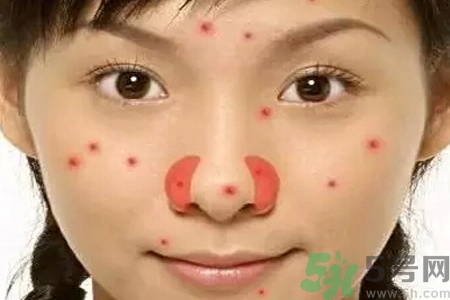鼻翼長痘痘怎么回事？鼻翼長痘痘的原因是什么？