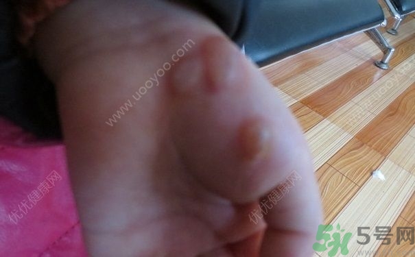 15歲還會得手足口病嗎？手足口病的癥狀有哪些？