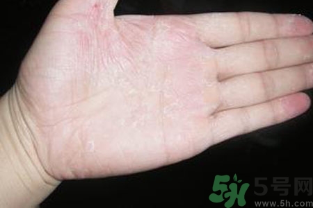 ?手掌脫皮的危害有哪些？如何預(yù)防手掌脫皮？