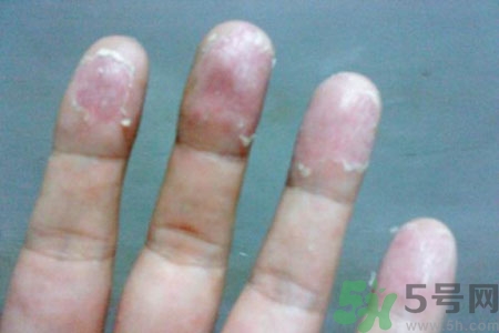 ?手掌脫皮的危害有哪些？如何預(yù)防手掌脫皮？