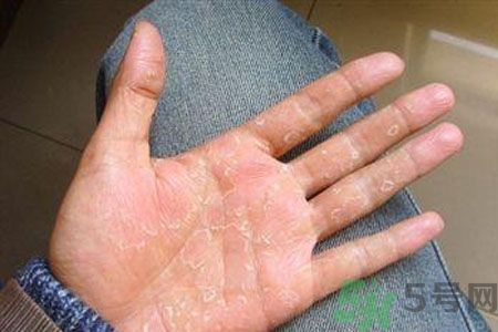?手掌脫皮的危害有哪些？如何預(yù)防手掌脫皮？