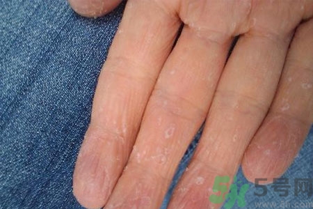 ?手掌脫皮的危害有哪些？如何預(yù)防手掌脫皮？