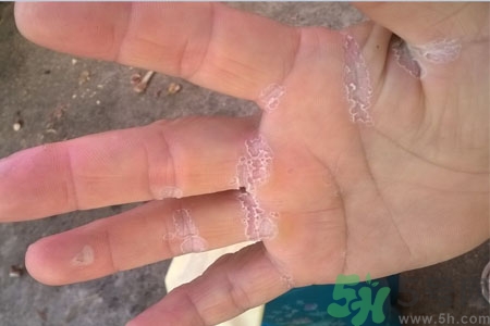 ?手掌脫皮的危害有哪些？如何預(yù)防手掌脫皮？