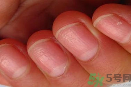 手指甲凹凸不平是怎么回事？如何預(yù)防手指甲凹凸不平？