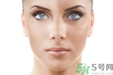 激光縮毛孔多少錢(qián)一次？激光縮毛孔一個(gè)療程多少錢(qián)？