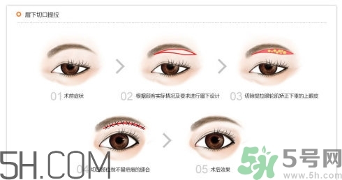 切眉手術(shù)后老得快嗎？切眉能保持多久？