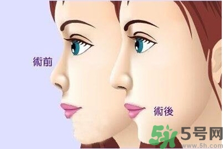 玻尿酸隆鼻的缺點是什么？玻尿酸隆鼻的優(yōu)點有哪些？