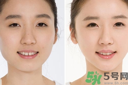 玻尿酸隆鼻的缺點是什么？玻尿酸隆鼻的優(yōu)點有哪些？