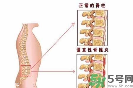 僵直性脊椎炎的癥狀有哪些？怎樣預防僵直性脊椎炎？