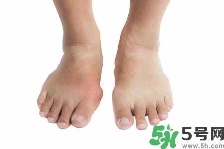 引發(fā)痛風(fēng)的原因是什么？痛風(fēng)病人飲食需注意什么好？
