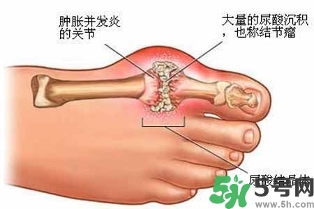 引發(fā)痛風(fēng)的原因是什么？痛風(fēng)病人飲食需注意什么好？
