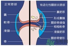 骨關(guān)節(jié)炎能治好嗎？骨關(guān)節(jié)炎平時(shí)注意事項(xiàng)