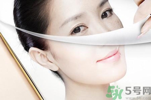 曬斑可以自己消退嗎？曬斑可以用激光去除嗎？