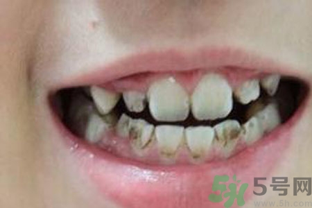 小孩牙齒發(fā)黑怎么回事？小孩牙齒發(fā)黑怎么辦？