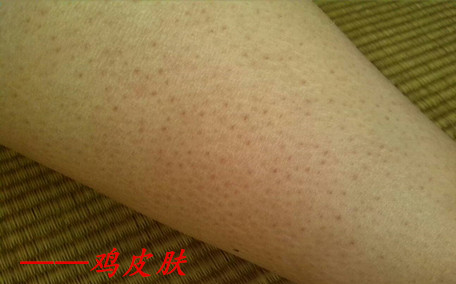 雞皮膚能不能治好 雞皮膚如何治療