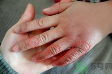 患凍瘡用溫水泡最好嗎？患凍瘡用熱水泡還是冷水泡好？