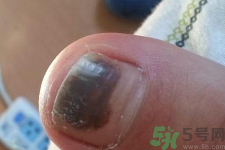 腳趾甲變黑是什么原因？腳趾甲變黑是怎么回事？