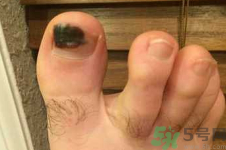 腳趾甲變黑是什么原因？腳趾甲變黑是怎么回事？