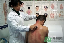 背部刮痧多久做一次比較好？刮痧經常做會有依賴性嗎？