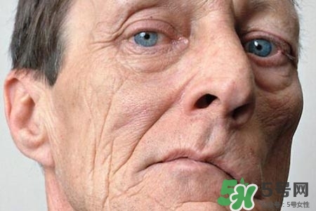 如何預防面癱復發？導致面癱的四大原因
