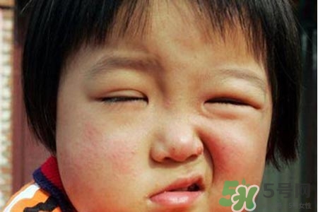 如何預防面癱復發？導致面癱的四大原因
