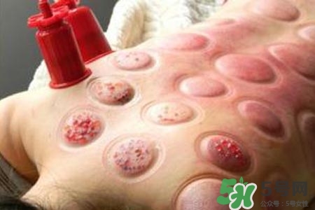 拔罐放血對身體好嗎？拔罐放血有什么好處？
