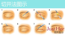 定點雙眼皮怎么做？定點雙眼皮需要拆線嗎？