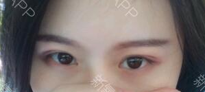 定點雙眼皮能保持多久？定點雙眼皮是永久的嗎？