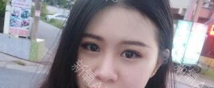 定點雙眼皮能保持多久？定點雙眼皮是永久的嗎？