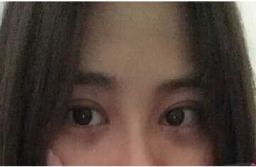 定點雙眼皮怎么做？定點雙眼皮需要拆線嗎？