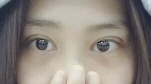 定點雙眼皮怎么做？定點雙眼皮需要拆線嗎？