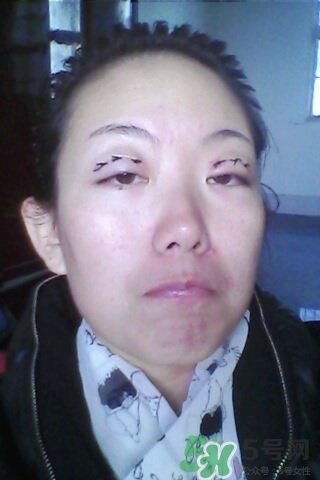 什么是定點雙眼皮？定點雙眼皮多少錢？