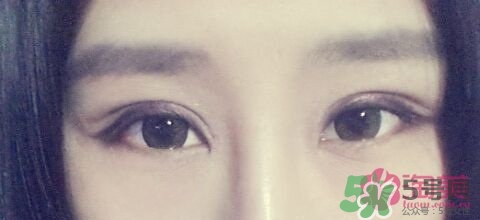 切開雙眼皮多久消腫？切開雙眼皮多久恢復？