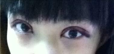 韓式三點(diǎn)雙眼皮是永久嗎？三點(diǎn)雙眼皮能保持多久？