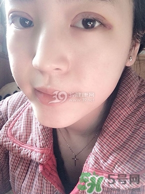 什么是定點雙眼皮？定點雙眼皮多少錢？