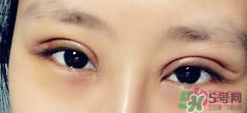 切開雙眼皮多久消腫？切開雙眼皮多久恢復？