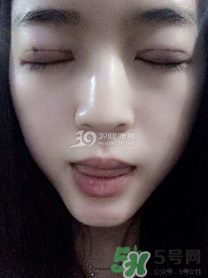 什么是定點雙眼皮？定點雙眼皮多少錢？