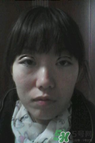 什么是定點雙眼皮？定點雙眼皮多少錢？