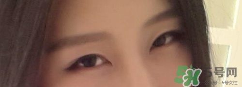 切開雙眼皮多久消腫？切開雙眼皮多久恢復？