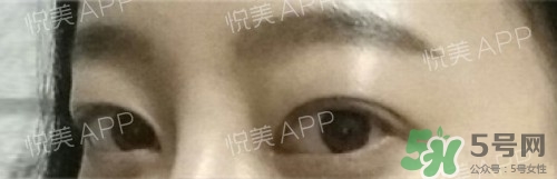 埋線雙眼皮多久恢復(fù)自然？埋線雙眼皮多久能恢復(fù)