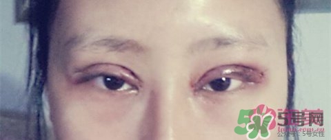 切開雙眼皮多久消腫？切開雙眼皮多久恢復？