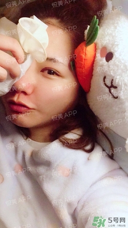 定點雙眼皮恢復過程圖_定點雙眼皮要多久恢復