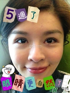 重瞼術(shù)是什么？重瞼術(shù)是永久的嗎？