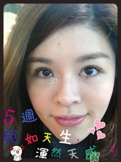 重瞼術(shù)是什么？重瞼術(shù)是永久的嗎？