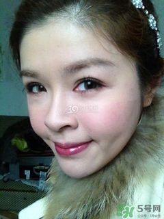 重瞼術(shù)是什么？重瞼術(shù)是永久的嗎？