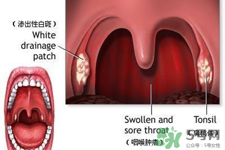 霧霾天喉嚨痛怎么辦？霧霾天嗓子疼怎么辦？