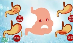 神經性胃痙攣是什么？神經性胃痙攣是什么原因？