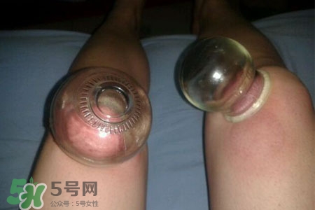 拔罐瘦腿真的有效嗎？腿部拔火罐減肥效果好嗎？