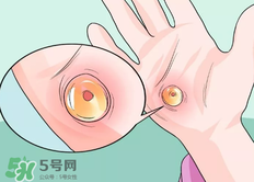 水泡怎么處理？水泡要不要刺破？