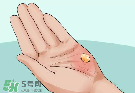 水泡怎么處理？水泡要不要刺破？